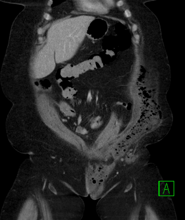 Fournier Gangrene Radiology Reference Article Radiopaedia Org