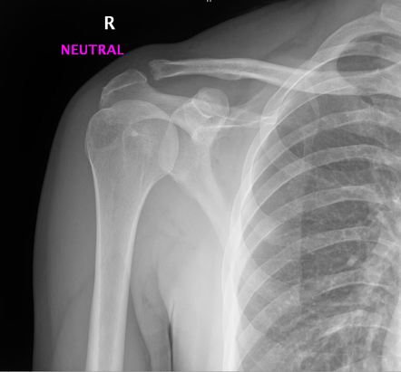 Pseudocyst Of The Humerus Radiology Reference Article Radiopaedia Org