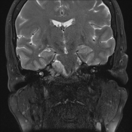 Meningioma Petrous Apex Image Radiopaedia Org