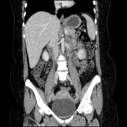 Acute Pyelonephritis Image Radiopaedia Org