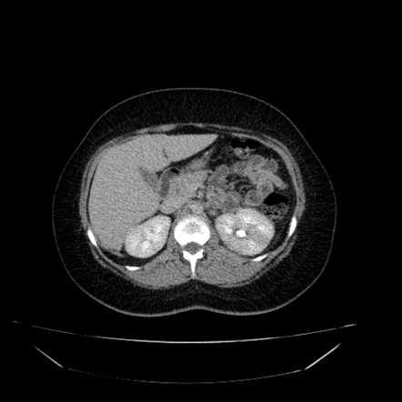 Acute Pyelonephritis Image Radiopaedia Org