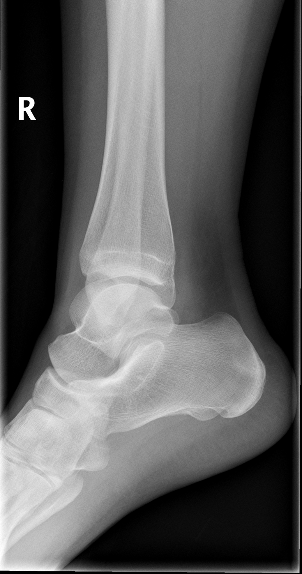 Talar Dome Osteochondral Injury Image Radiopaedia Org