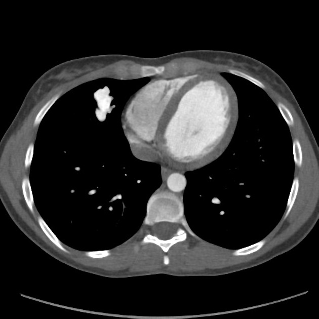 Pulmonary Arteriovenous Malformation Radiology Reference Article