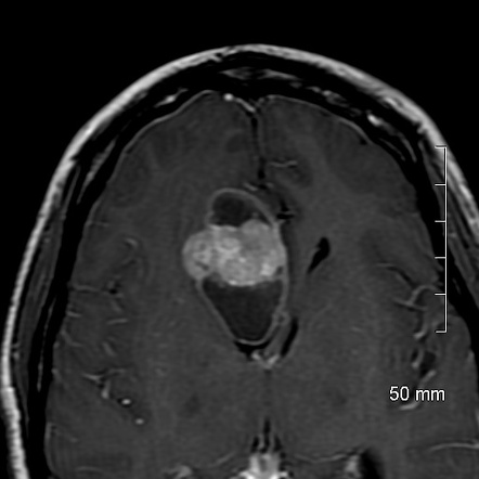 Rhabdoid Meningioma Radiology Reference Article Radiopaedia Org