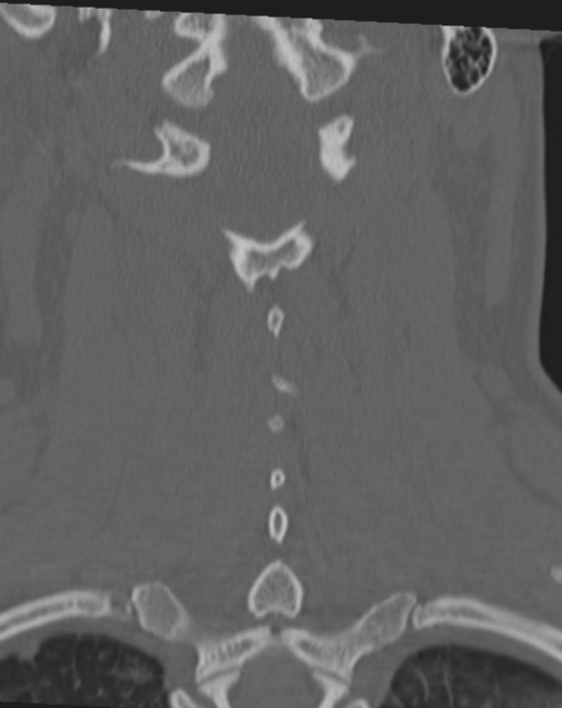 Atlanto Occipital Dissociation Image Radiopaedia Org