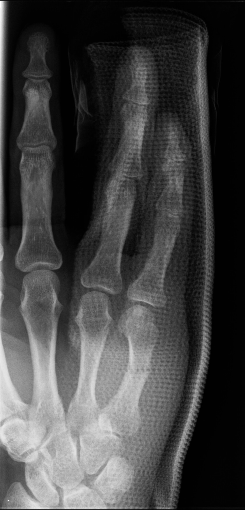 Fifth Metacarpal Fracture Image Radiopaedia Org