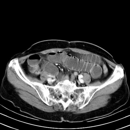 Small Bowel Obstruction Due To Incarcerated Femoral Hernia Radiology