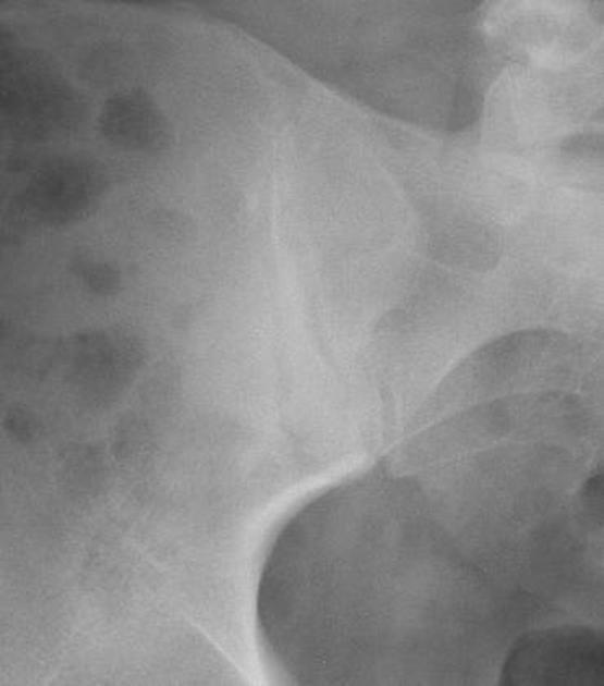 Normal Sacroiliac Joint Xray