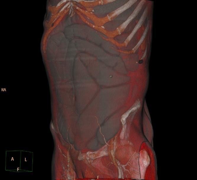 Paralytic Ileus Image Radiopaedia Org