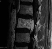 Aggressive Vertebral Hemangioma Radiology Reference Article