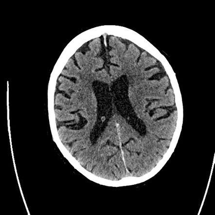 Viewing Playlist Cns Radiopaedia Org