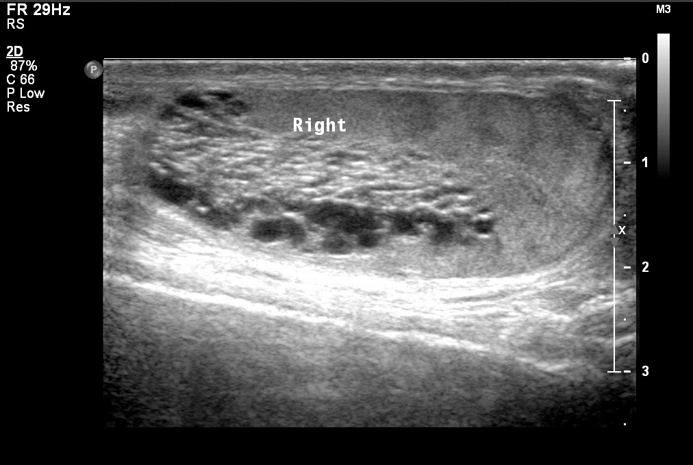 Tubular Ectasia Of Rete Testis Image Radiopaedia Org