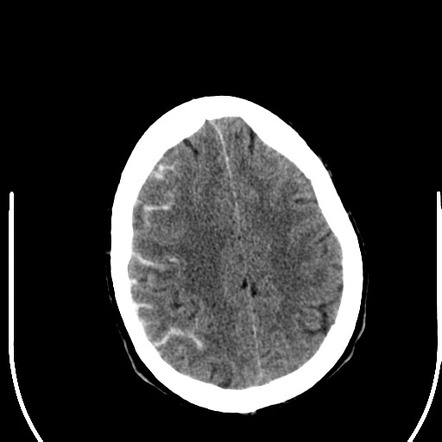 Convexal Subarachnoid Hemorrhage Radiology Reference Article