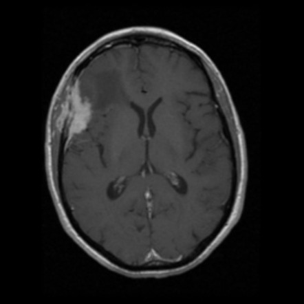 Anaplastic Meningioma Image Radiopaedia Org Hot Sex Picture