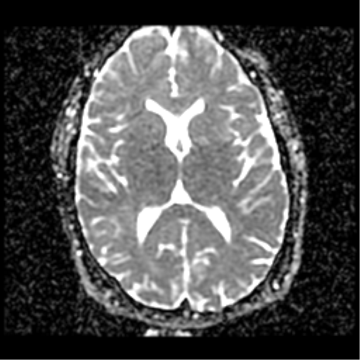 Arachnoid Cyst Frontal Image Radiopaedia Org