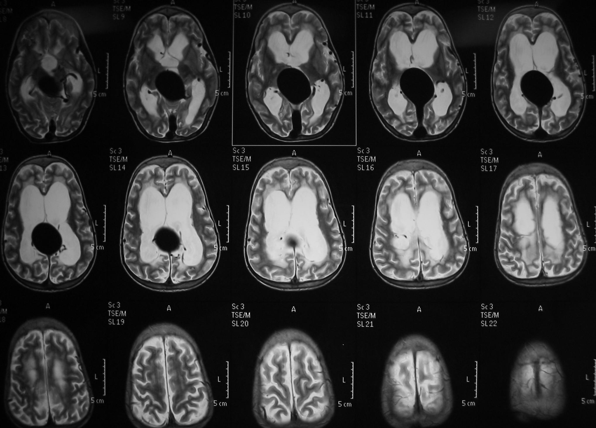 Vein Of Galen Malformation Image Radiopaedia Org