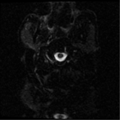 Ischemic Cerebellar Infarct With Early Hemorrhagic Transformation