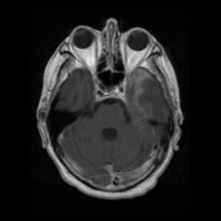 Gyral Enhancement Radiology Reference Article Radiopaedia Org