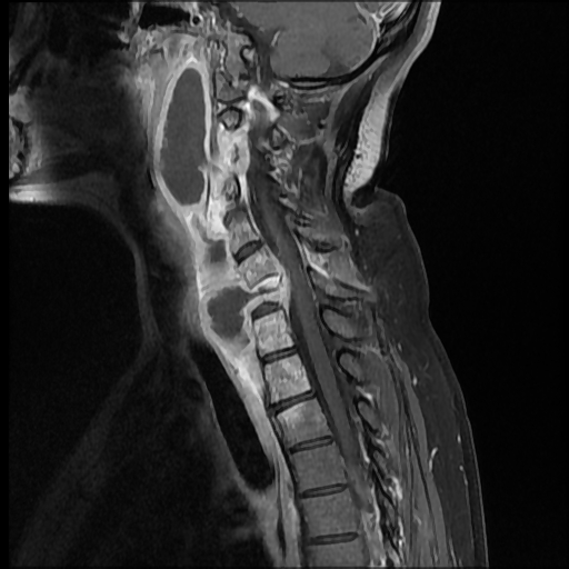 Pott Disease Image Radiopaedia Org