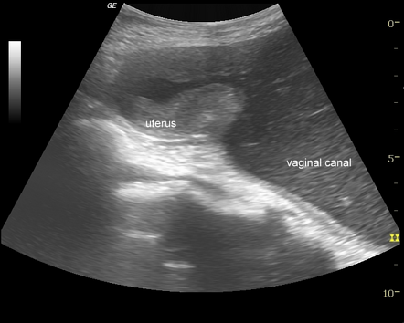 Imperforate Hymen Radiology Reference Article Radiopaedia Org