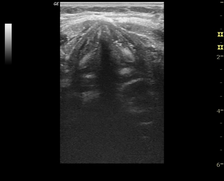 Normal Vocal Cords On Ultrasound Radiology Case Radiopaedia Org