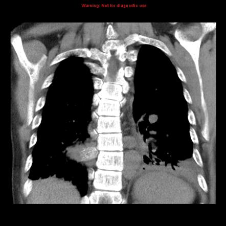 Extramedullary Hematopoiesis Radiology Reference Article