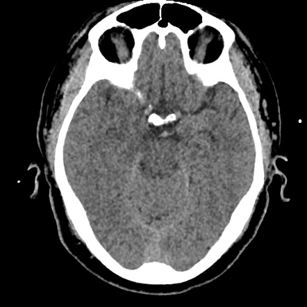 Viewing Playlist Ncct Head Radiopaedia Org