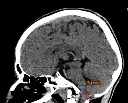 Chiari I Malformation Radiology Reference Article Radiopaedia Org