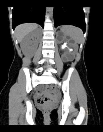 Xanthogranulomatous Pyelonephritis Radiology Case Radiopaedia Org