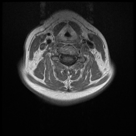 Normal Cervical And Thoracic Spine Mri Image Radiopaedia Org