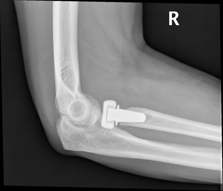 Radial Head Replacement Radiology Case Radiopaedia Org