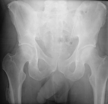 Throckmorton Sign Pelvis Radiology Reference Article Radiopaedia Org