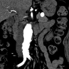 Splenic Artery Aneurysm Image Radiopaedia Org