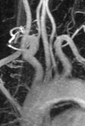 Aortic Arch Origin Of Left Vertebral Artery Radiology Case