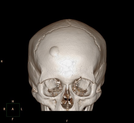 Calvarial Osteoma Image Radiopaedia Org