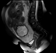 Placenta Previa And Accreta Image Radiopaedia Org