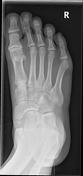 Accessory Navicular Radiology Reference Article Radiopaedia Org