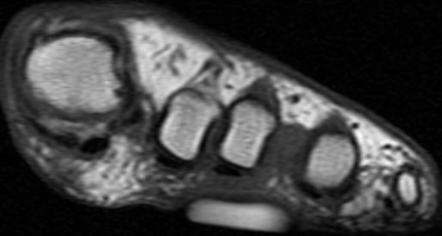 Morton Neuroma Image Radiopaedia Org