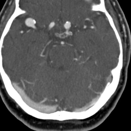 Saccular Cerebral Aneurysm Radiology Reference Article Radiopaedia Org