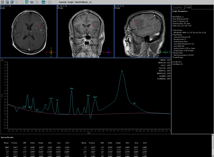 Subacute Cerebral Infarction With Mr Spectroscopy Image