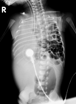 Congenital Diaphragmatic Hernia Radiology Case Radiopaedia Org