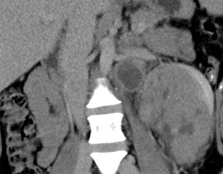 Renal Cell Carcinoma Radiology Case Radiopaedia Org