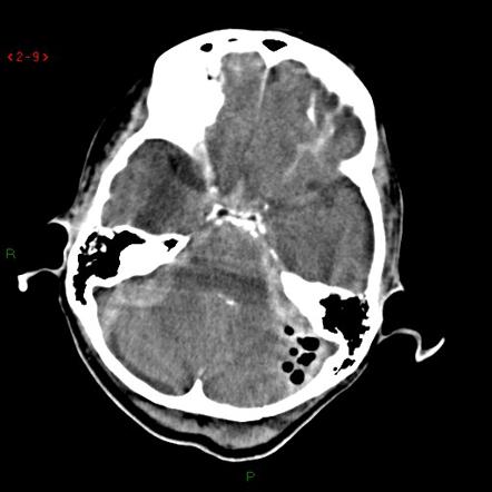 Subarachnoid Haemorrhage Radiology Reference Article Radiopaedia Org