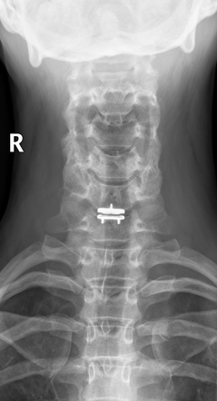 Cervical Disc Arthroplasty Radiology Reference Article Radiopaedia Org