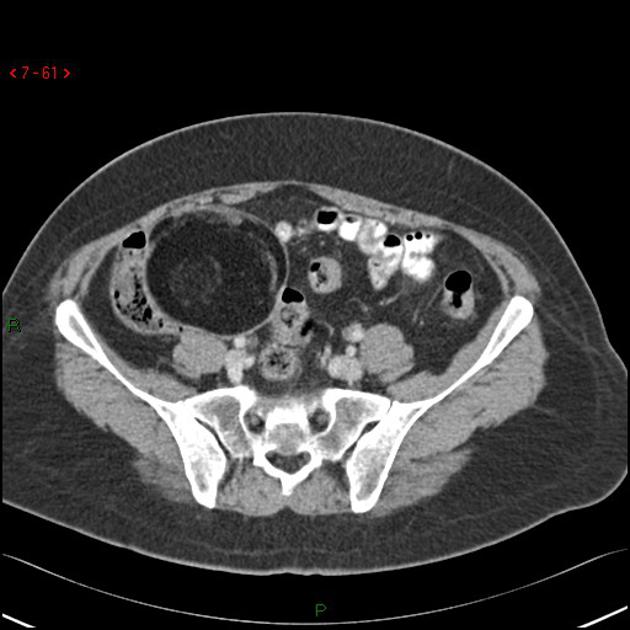 Mature Cystic Ovarian Teratoma Radiology Reference Article