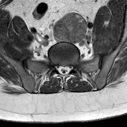 Pelvic Schwannoma Image Radiopaedia Org