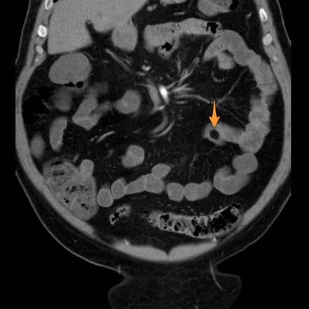 Gastrointestinal Tract Lipomas Radiology Reference Article