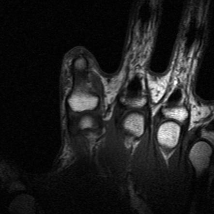 Amputation Neuroma Image Radiopaedia Org