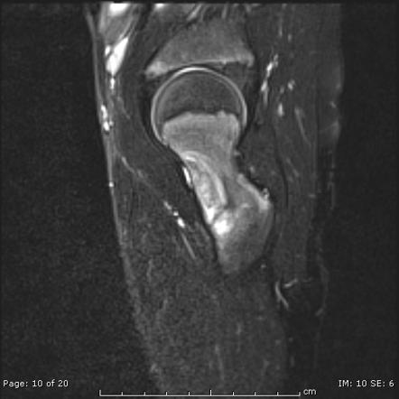 Osteoblastoma Image Radiopaedia Org