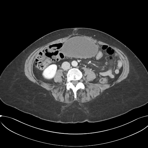 Gallbladder Hydrops Image Radiopaedia Org